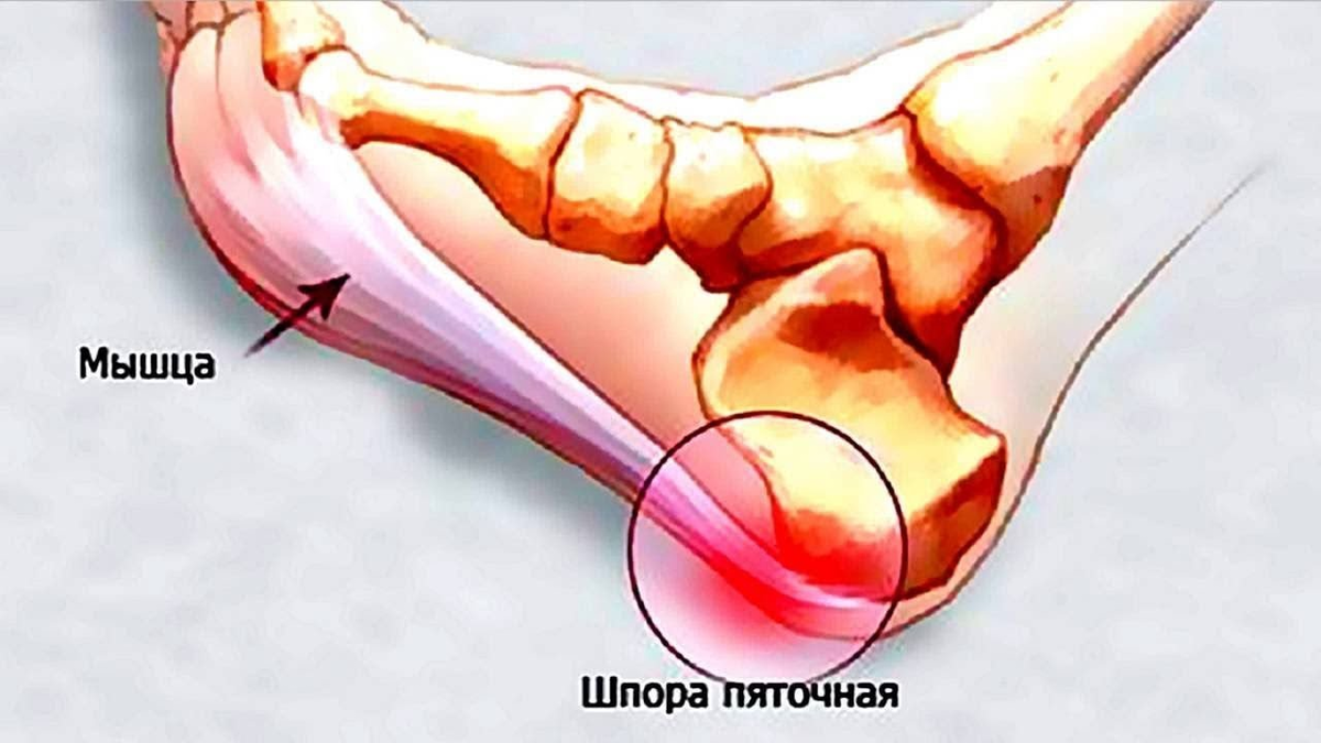 Плантарный фасциит рентген. Подошвенный (плантарный) фасциит клиника. Плантарный фасциит блокада. Пяточная шпора плантарный фасциит.