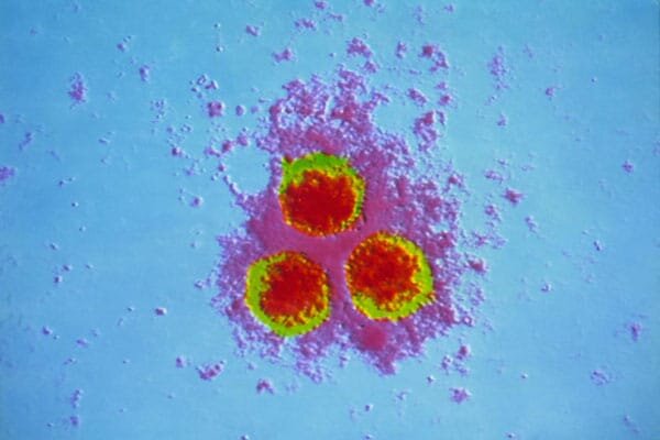    Varicella zoster, относящийся к семейству герпетических вирусов, во внешней среде неустойчив и быстро погибает. Единственным источник инфекции — человек / © Clinical Advisor