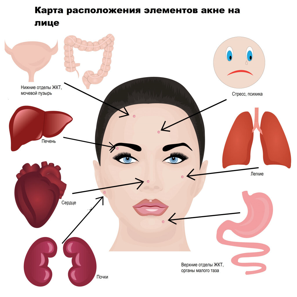 Причины и лечение подкожных прыщей