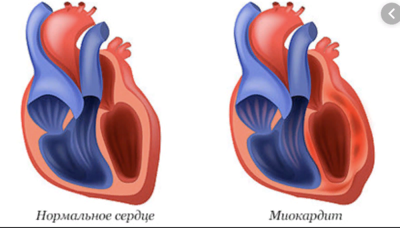 Миокардит- воспаление сердечной мышцы.