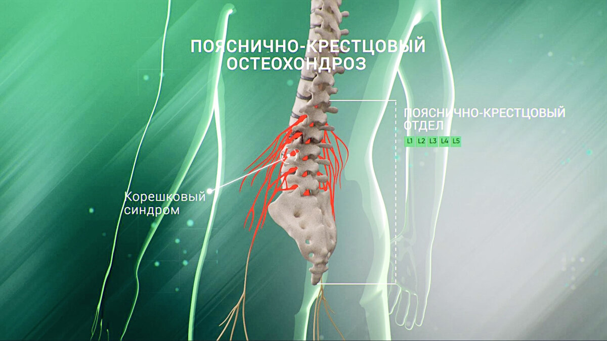 Как совместить занятия спортом и невралгию | Павел Корпачев | Дзен