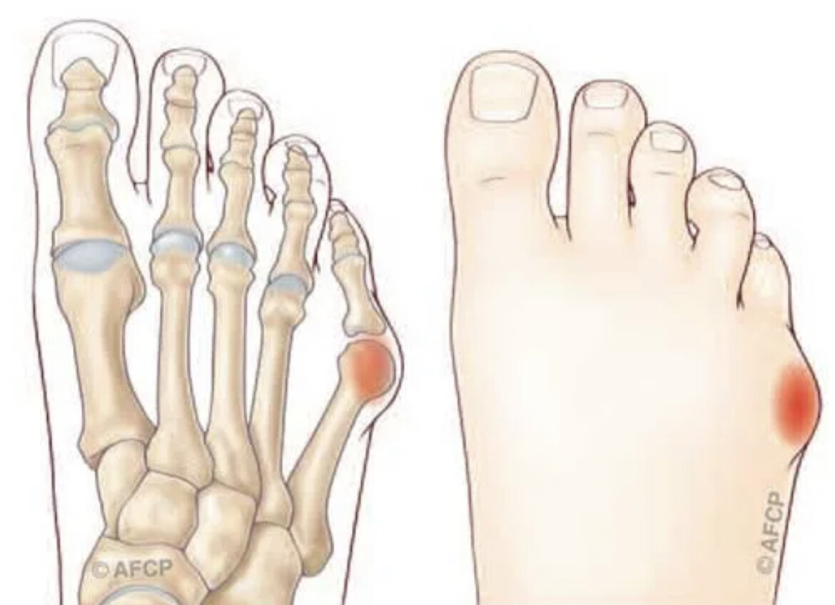 Проблема: сводит судорогой пальцы ног