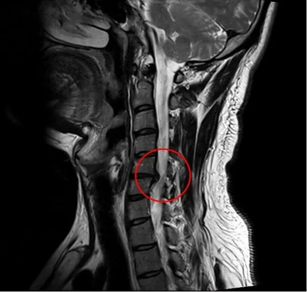 Симптомы грыжи шейного отдела позвоночника. Грыжа шейного отдела позвоночника мрт. Междисковые грыжи шейного отдела. Грыжа шейных позвонков с3 с4. Мрт шеи позвонки с5.