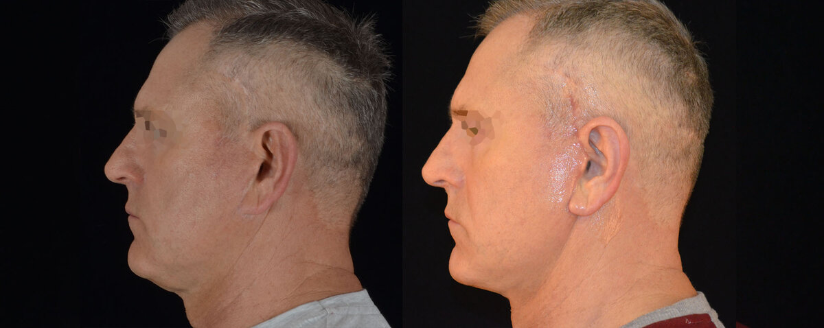 Подтяжка лица SMAS фото до и после. Фото с сайта Д.Р. Гришкяна. Имеются противопоказания, требуется консультация специалиста