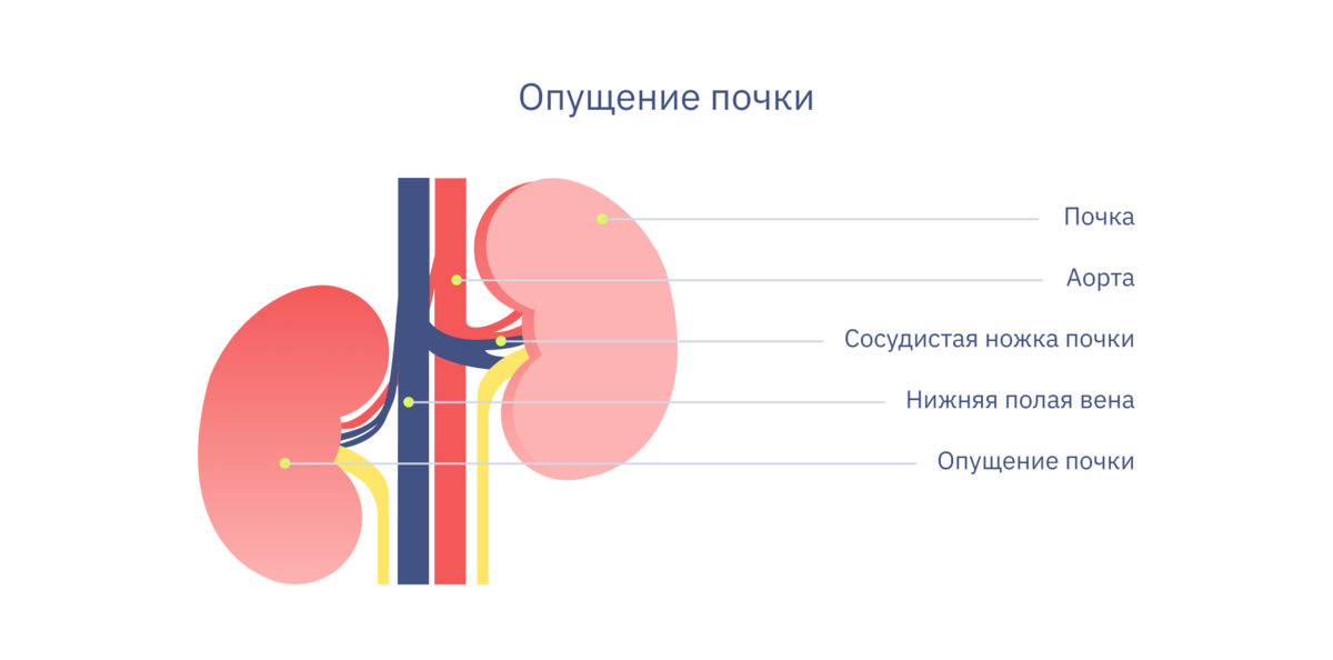 Опущение почки причины