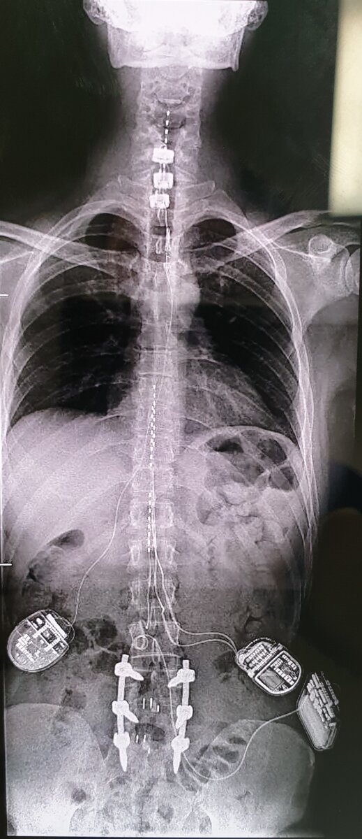 Рентген пациента N, - киборга. 