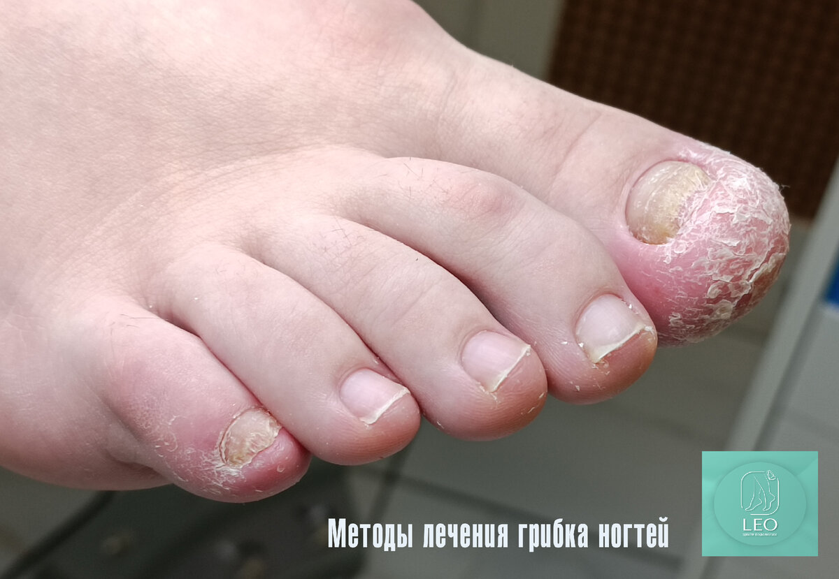 Методы лечения грибка | Leo Beauty | Центр Подологии. Москва | Дзен