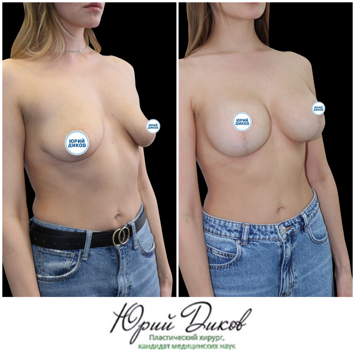 разные импланты на одну грудь фото 14