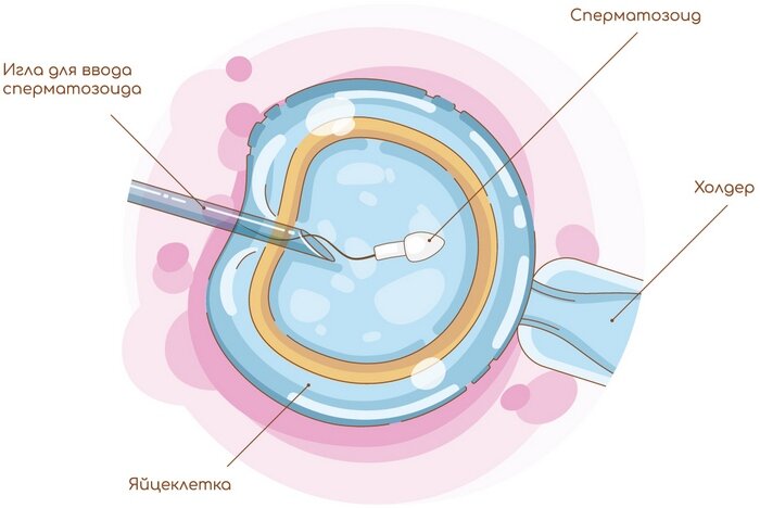 Процедура ЭКО + ИКСИ
