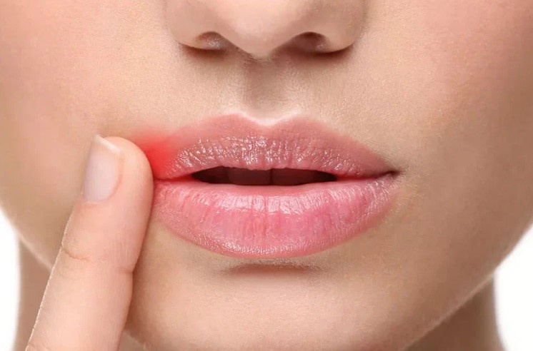 Хейлит: почему шелушатся губы?