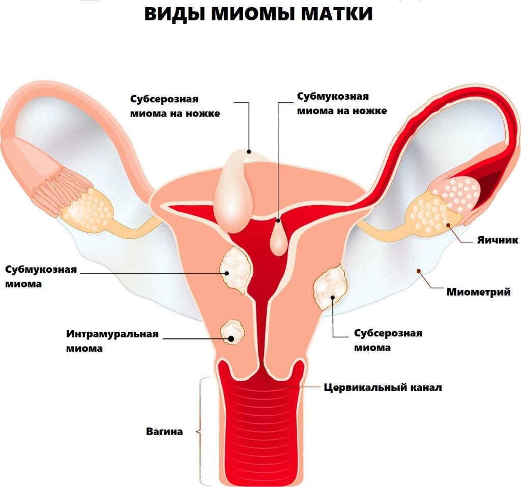 Что такое миома и как она образуется