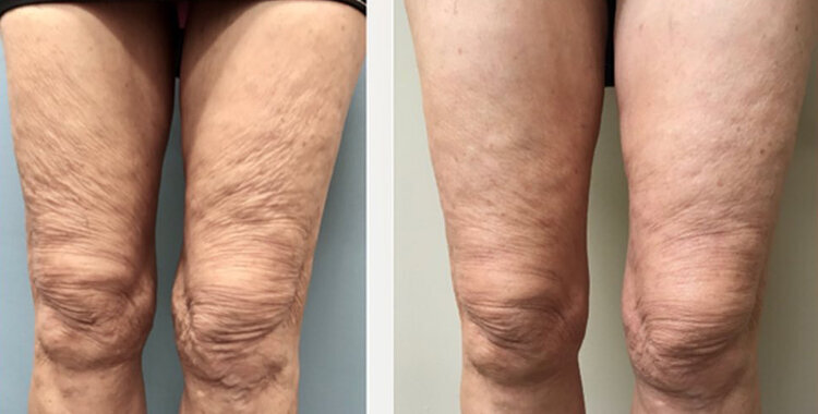 Сухая кожа на ногах: причины, симптомы и методы увлажнения