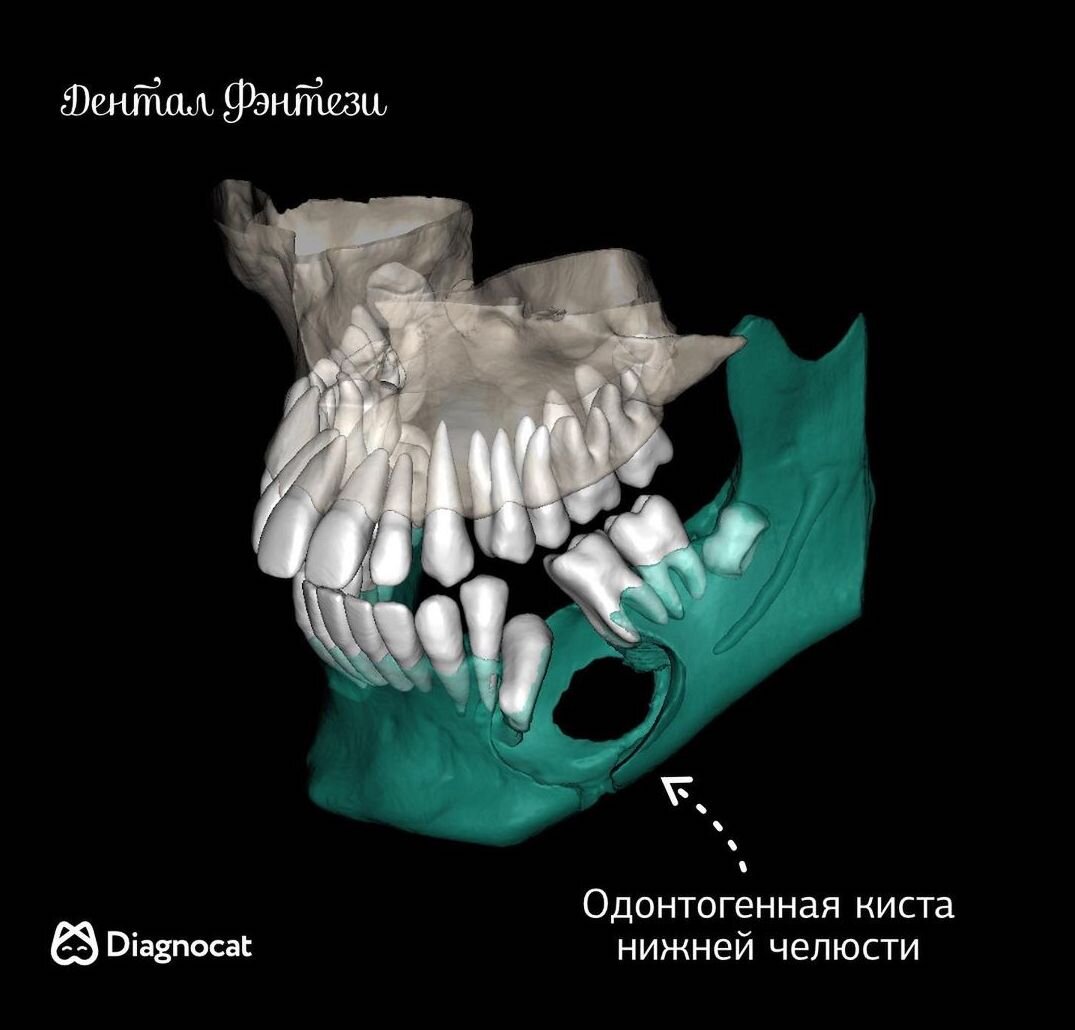 Лечение кисты зуба в стоматологической клинике «Эдельвейс»