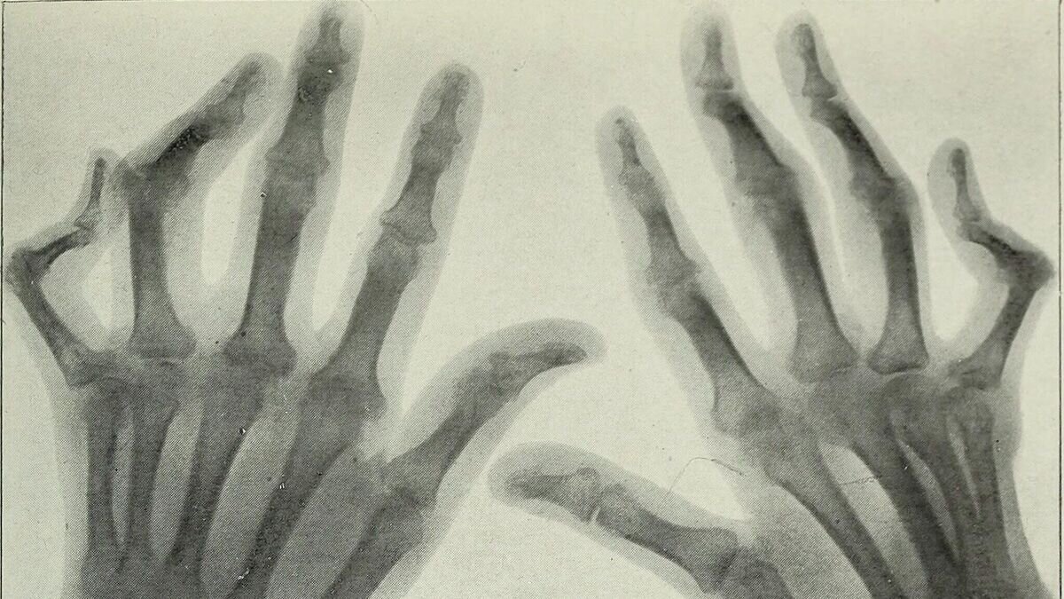    Руки человека, пораженного артритомCC0 / Internet Archive Book Images /
