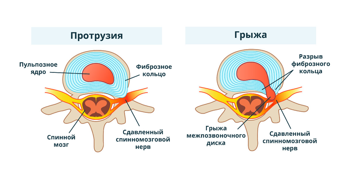 Протрузия диска в поясничном отделе