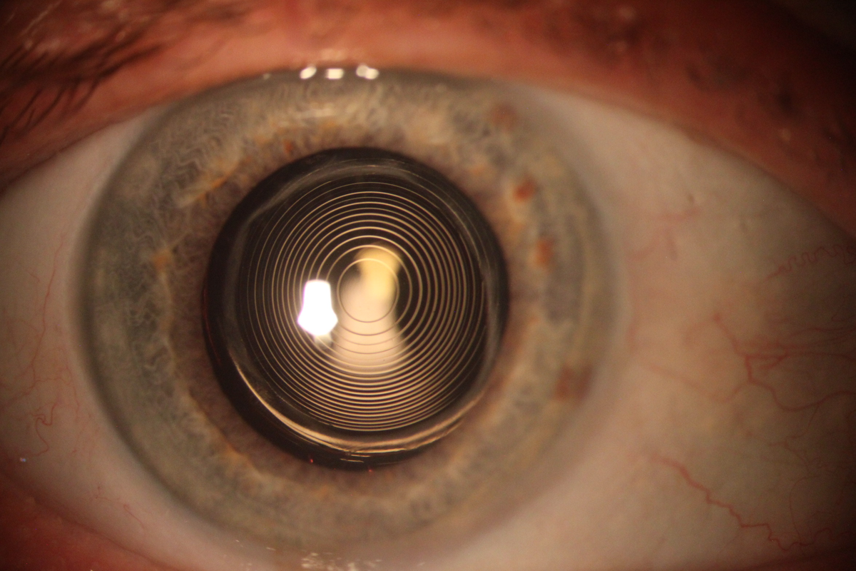 Линзы в глаза операция. Мультифокальные ИОЛ катаракта. Заднекапсулярная катаракта.