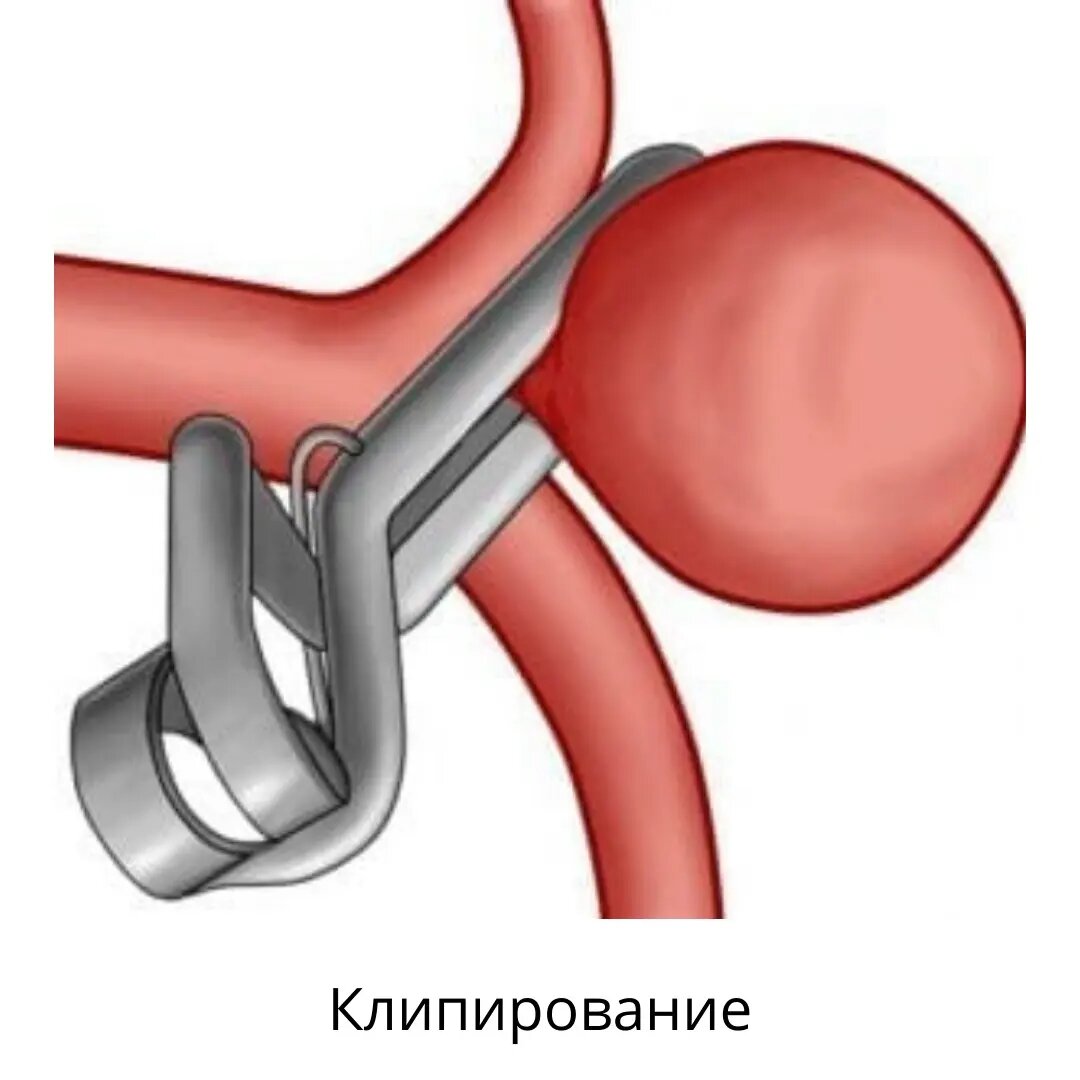 Атеросклероз экстракраниального отдела. Аневризма периферических артерий. Аневризматический.