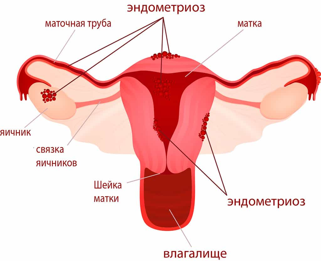 Беременность - отмена дюфастона