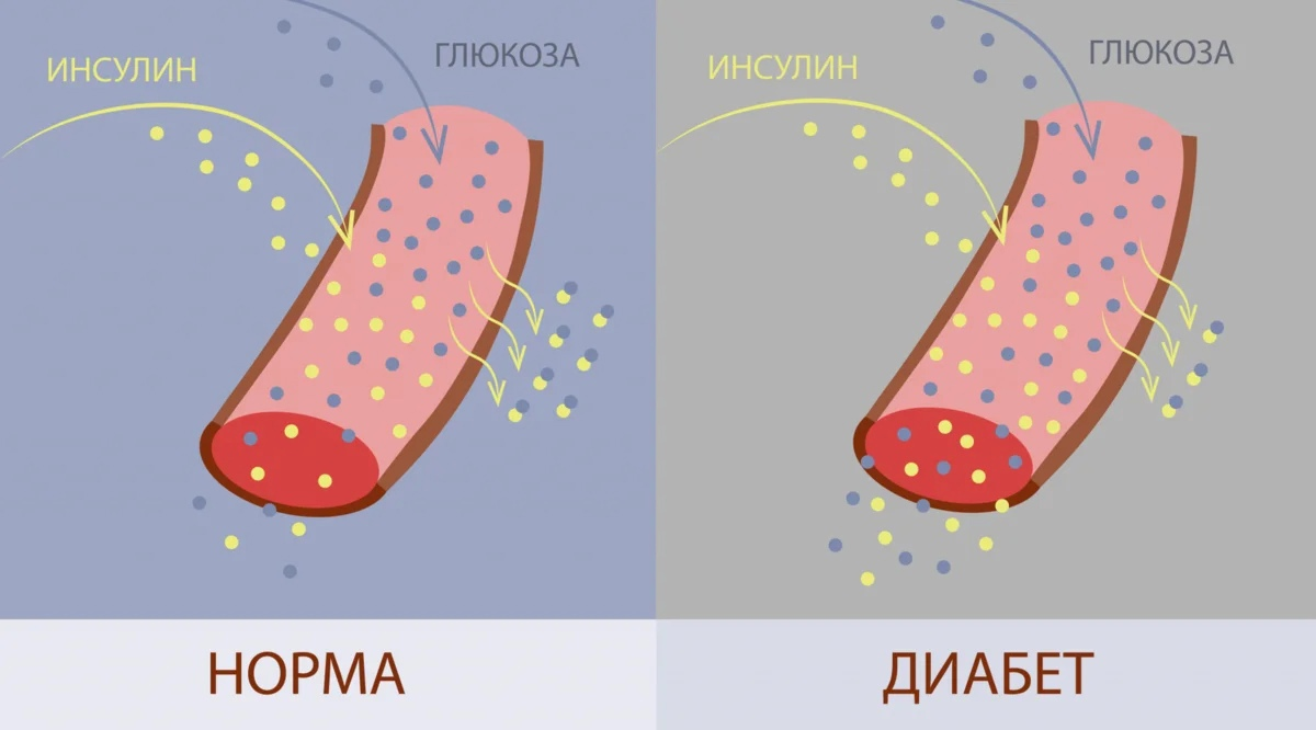 Большое количество глюкозы в крови. Сосуды при сахарном диабете. Диабет иллюстрация. Сахарный диабет инсулин. Сахарный диабет Глюкоза в крови.