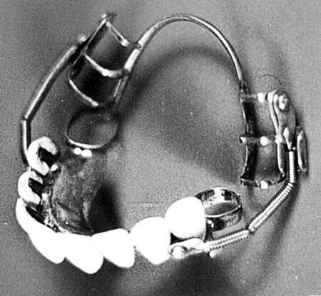 фарфоровый протез 1 века