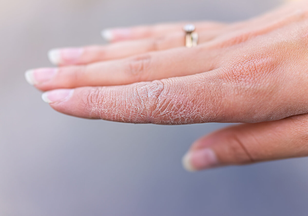 «Почему облазит кожа на пальцах рук?» — Яндекс Кью