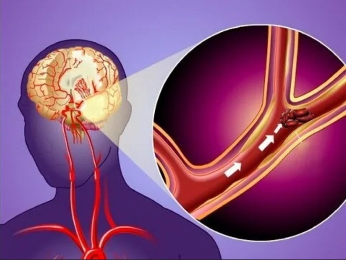 Изображение взято из открытых источников. Острый ишемический инсульт.