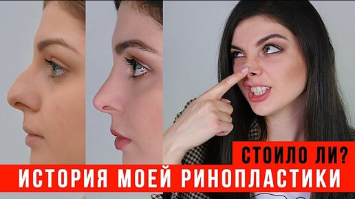 РИНОПЛАСТИКА | МОЯ ИСТОРИЯ Довольна ли я результатом?