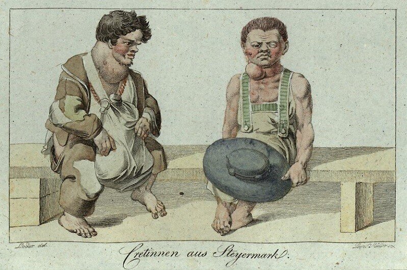 Больные кретинизмом люди. Фото с сайта https://m.fishki.net/3596439-10-ljubopytnyh-istorij-proishozhdenija-slov-i-vyrazhenij/gallery-8694837-kretin-photo.html