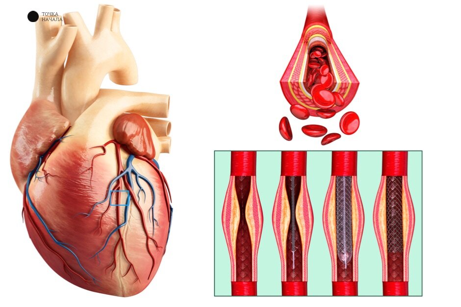 Инфаркт миокарда (сердечный приступ) - причины, симптомы, первая помощь