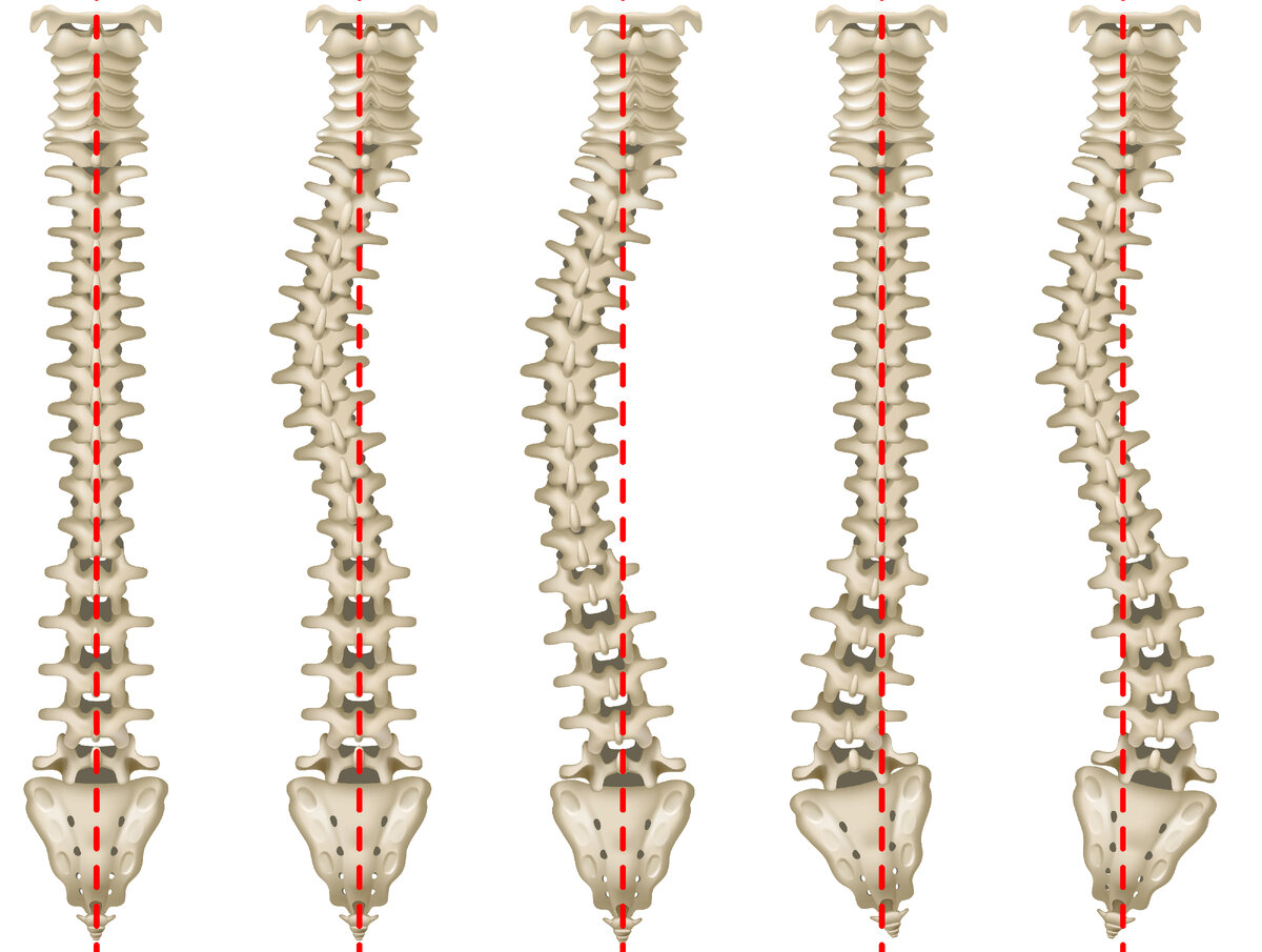 Как выглядит сколиоз 2 степени. Сколиоз 1 степени искривления позвоночника. Сколиоз грудного отдела позвоночника 1ст. Правосторонний сколиоз 1 степени поясничного отдела позвоночника. Правосторонний сколиоз 2 степени поясничного отдела.