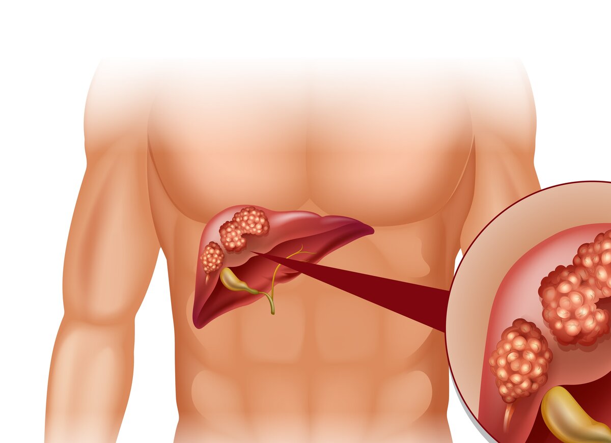 Рак печени. Картинка из инета.