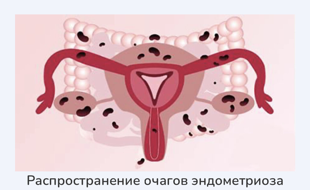 Хроническая тазовая боль и эндометриоз ::Первый Севастопольский