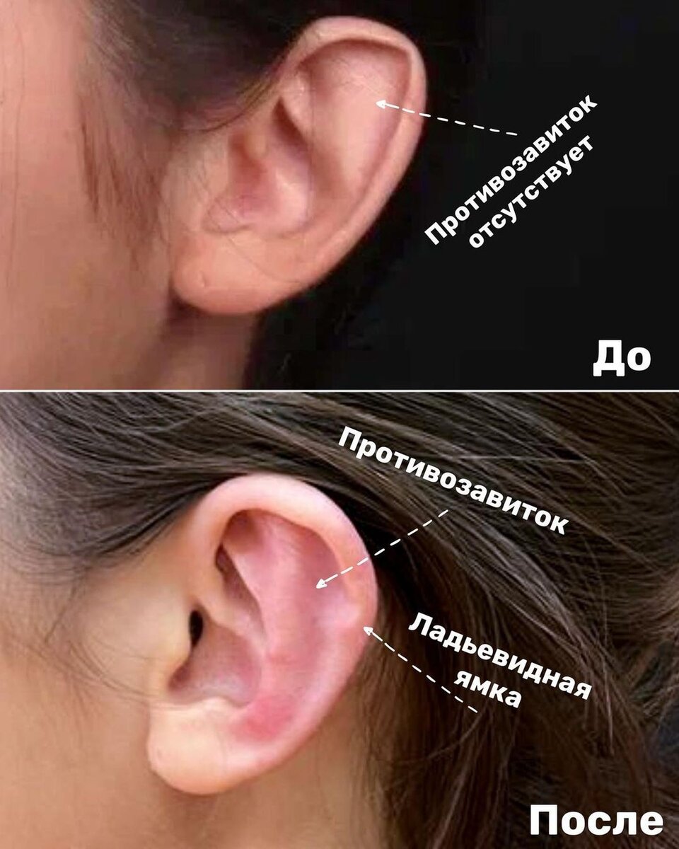 Создала противозавиток и ладьевидную ямку, которые с рождения отсутствовали