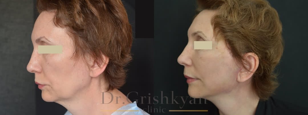 Вертикальный SMAS-лифт и пластика шеи фото до и после. Фото с сайта Д.Р. Гришкяна. Имеются противопоказания, требуется консультация специалиста