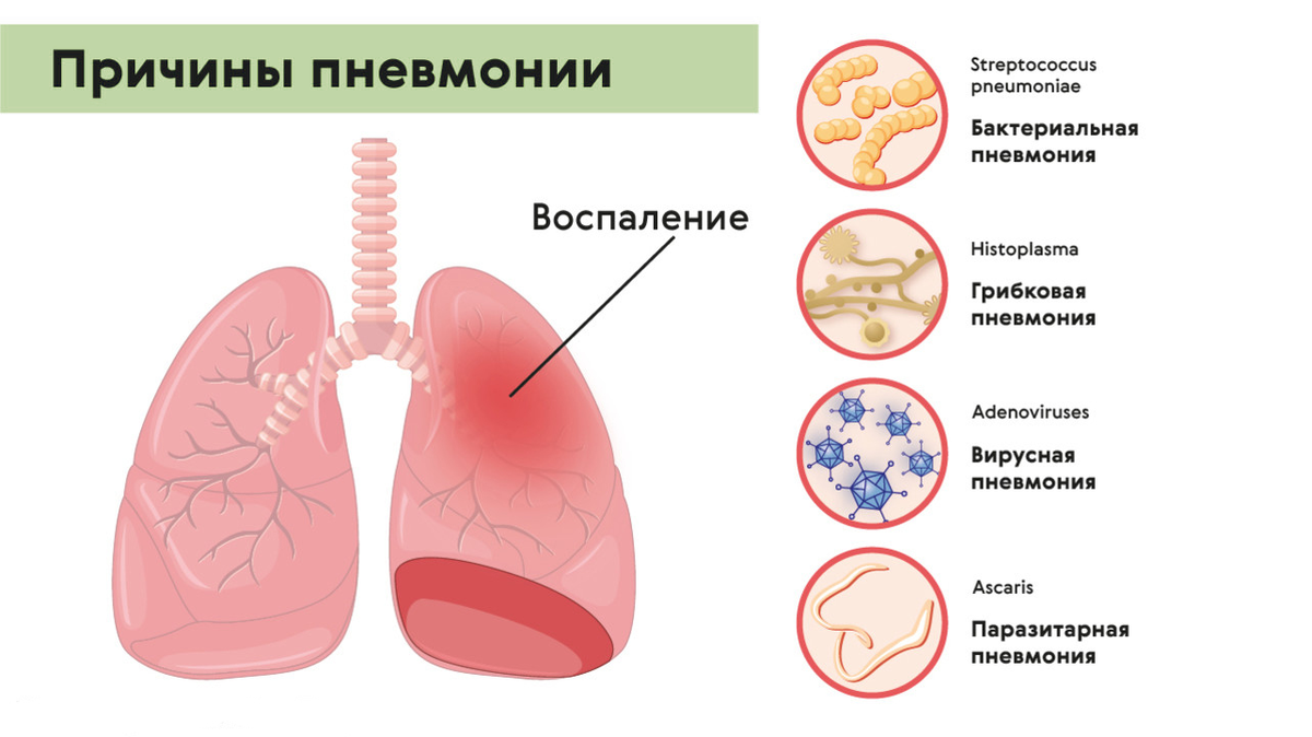 Как развивается и сколько дней в среднем длится пневмония: чем опасна эта  болезнь? | О здоровье: с медицинского на русский | Дзен