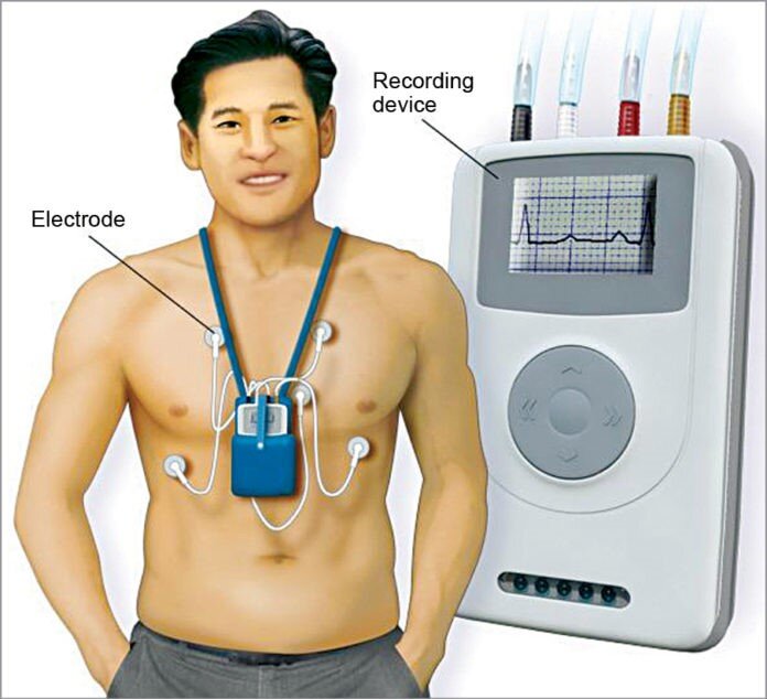 Холтер зачем. Холтер монитор ЭКГ. Holter monitoring Холтер ЭКГ. Суточный монитор ЭКГ И ад. Холтеровское мониторирование (хм-ЭКГ).