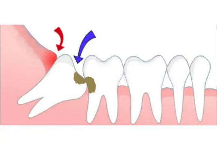Ретинированный дистопированный зуб мудрости. Десневой капюшон зуб мудрости. Зуб 8 корень
