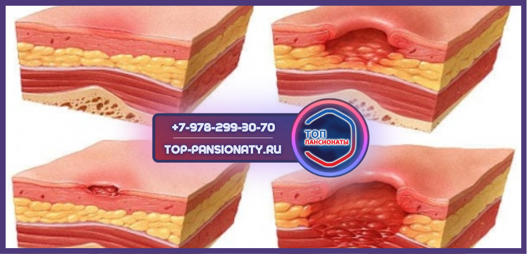 Пролежни – это язвочки на поверхности кожи.