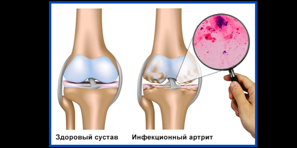 Артрит коленного сустава в домашних условиях