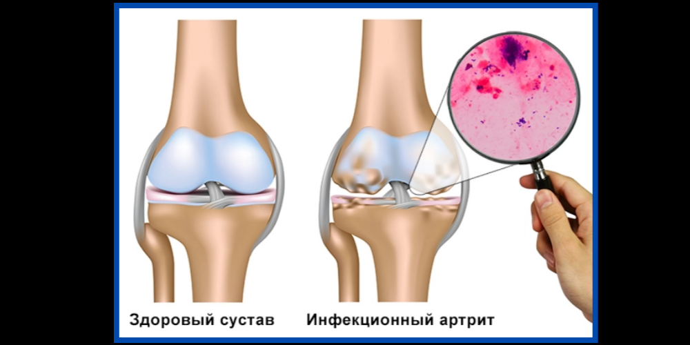 Артроз коленного сустава воспаление
