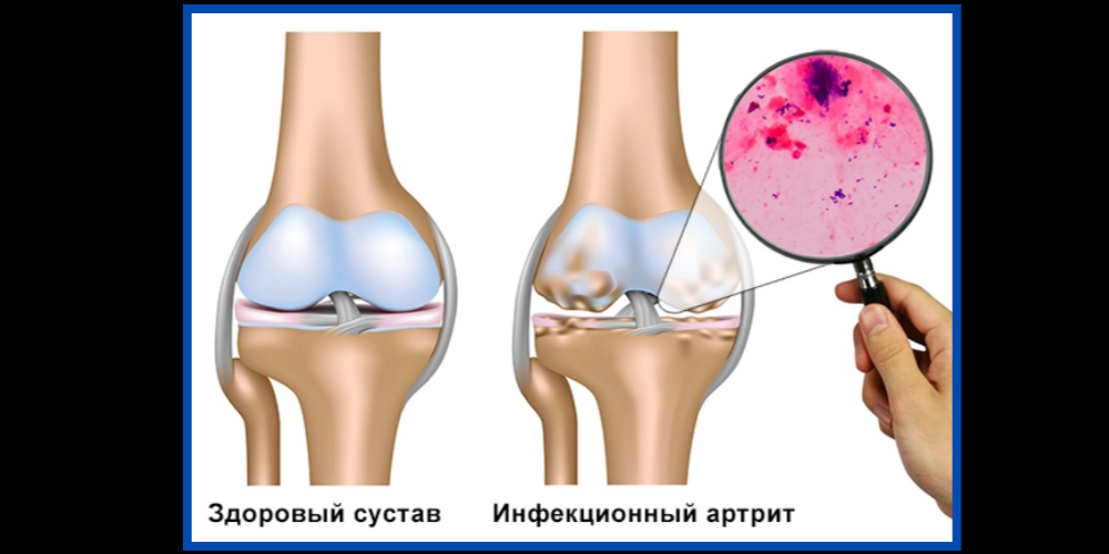 Гнойные заболевания суставов