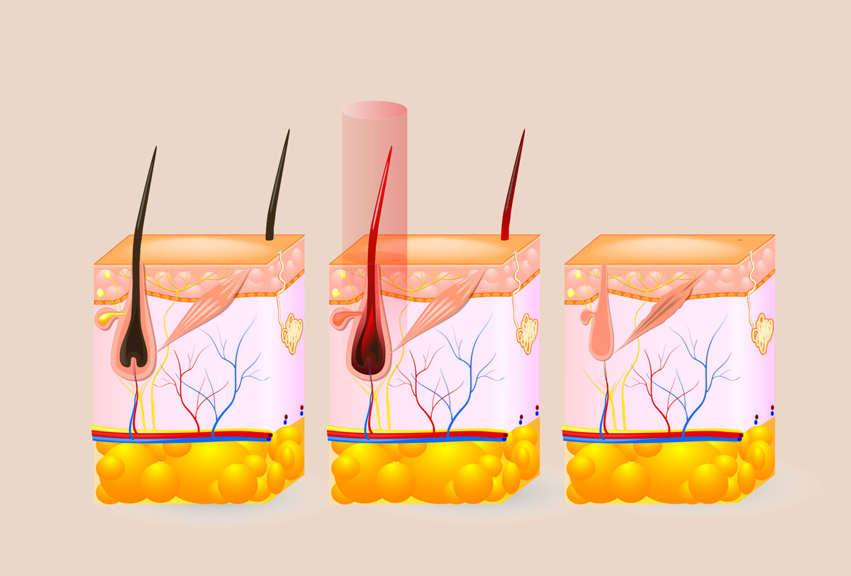 "Лазерная эпиляция вызывает рак!?"- запомните раз и на всегда ...