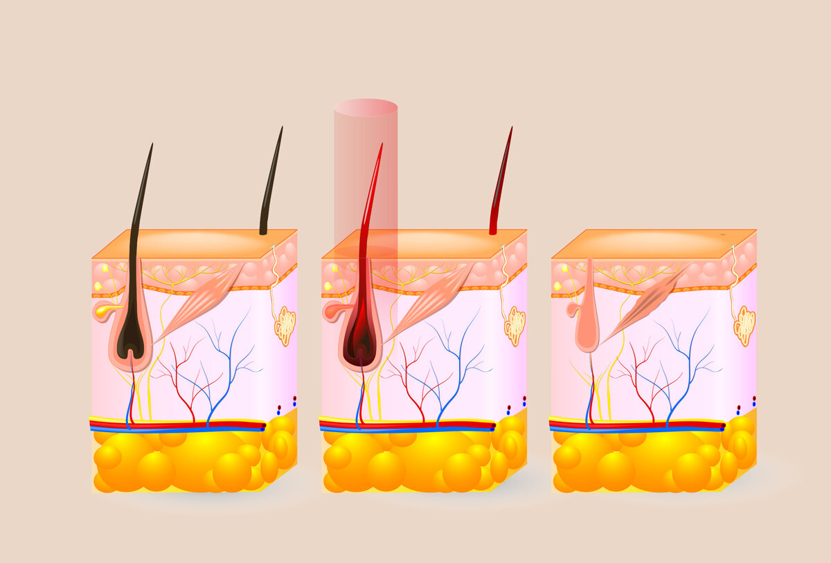 Электроэпиляция и лазерная отличия. Строение волоса лазерная эпиляция. Воздействие диодного лазера на волосы. Воздействие лазера на волос при эпиляции. Схема диодного лазера для эпиляции.