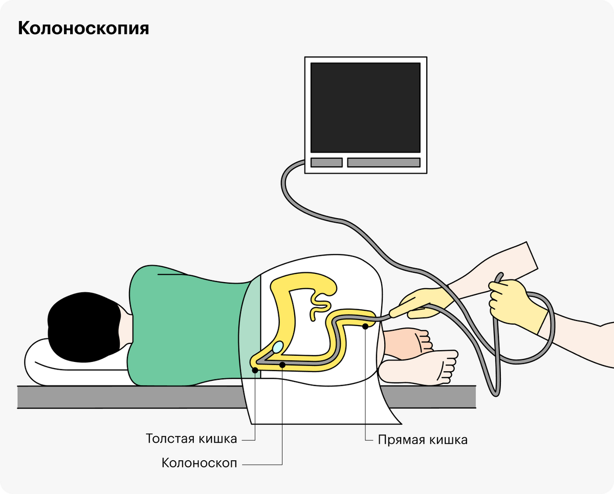 Как проходит процедура колоноскопии