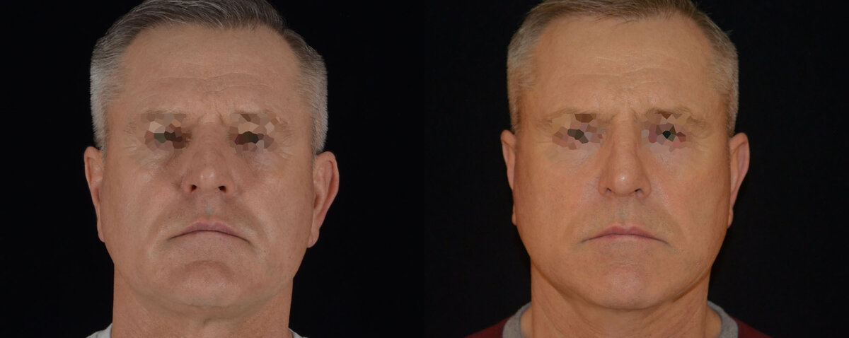 Подтяжка лица SMAS фото до и после. Фото с сайта Д.Р. Гришкяна. Имеются противопоказания, требуется консультация специалиста