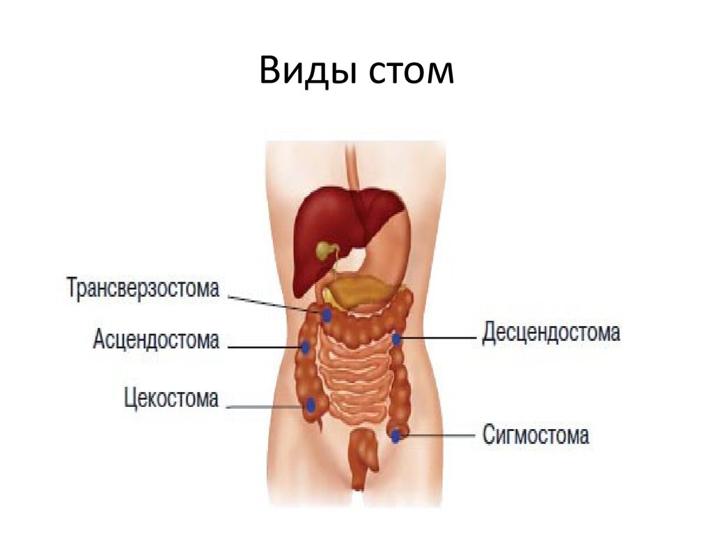 Виды стом презентация