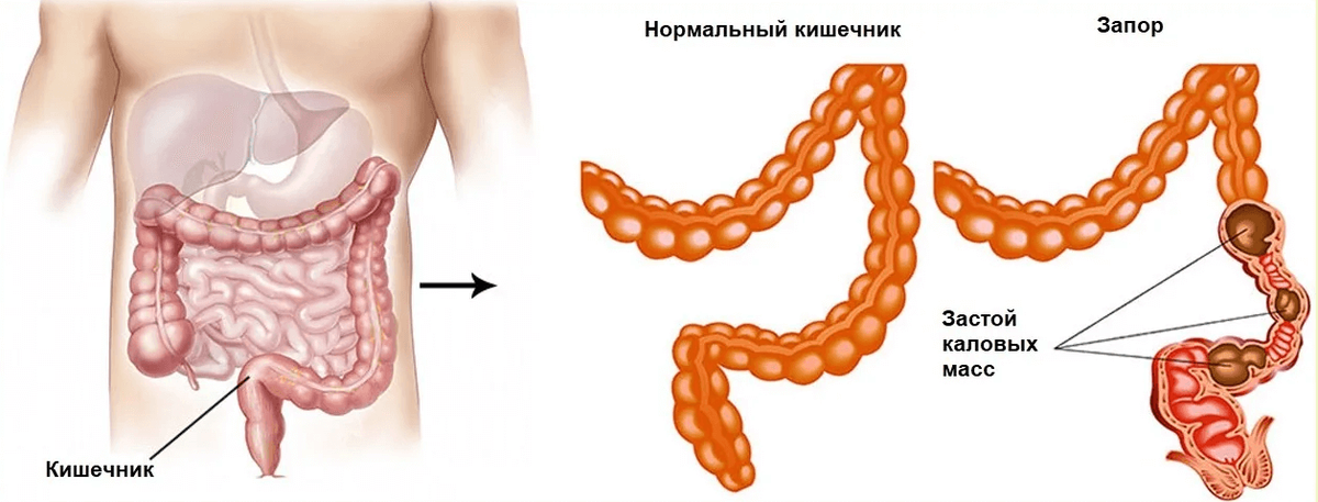 Что такое запор. Спастический запор. Каловые массы в кишечнике.