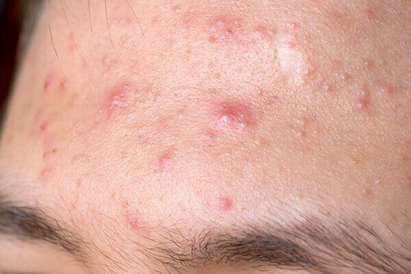 Папулезные угри.