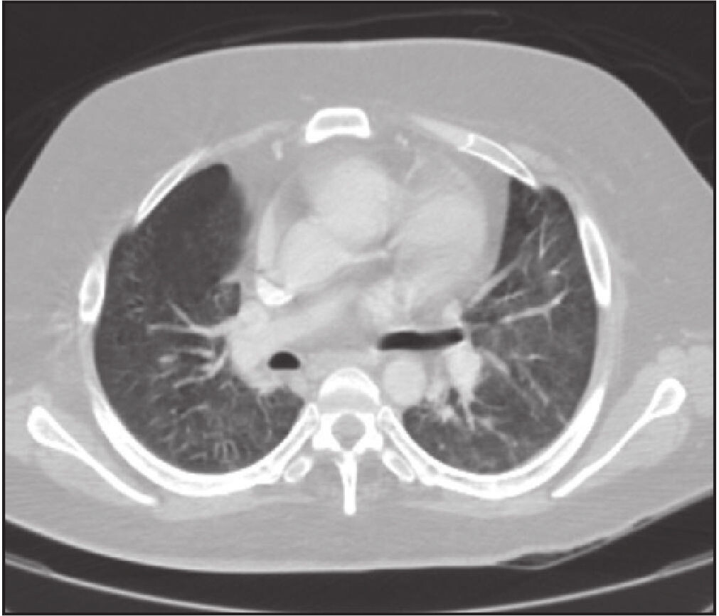 На снимке показано двустороннее явление «матового стекла» обоих легких.
