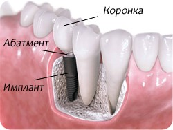 🔎 Коротко Протезирование — это любая процедура по восстановлению утраченных или сильно разрушенных зубов. Искусственную конструкцию, которая заменяет собой зуб или его часть, называют протезом.-8